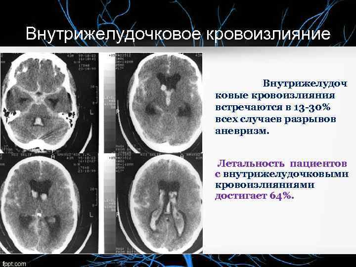 Внутрижелудочковое кровоизлияние Внутрижелудоч ковые кровоизлияния встречаются в 13 -30% всех случаев разрывов аневризм. Летальность