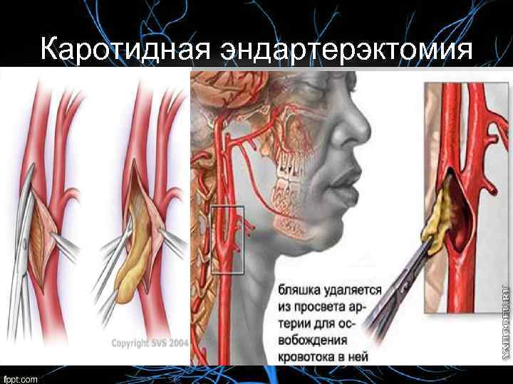 После каротидной эндартерэктомии. Эндартерэктомия сонной артерии. Эверсионная каротидная эндартерэктомия. Кюретажная эндартерэктомия.