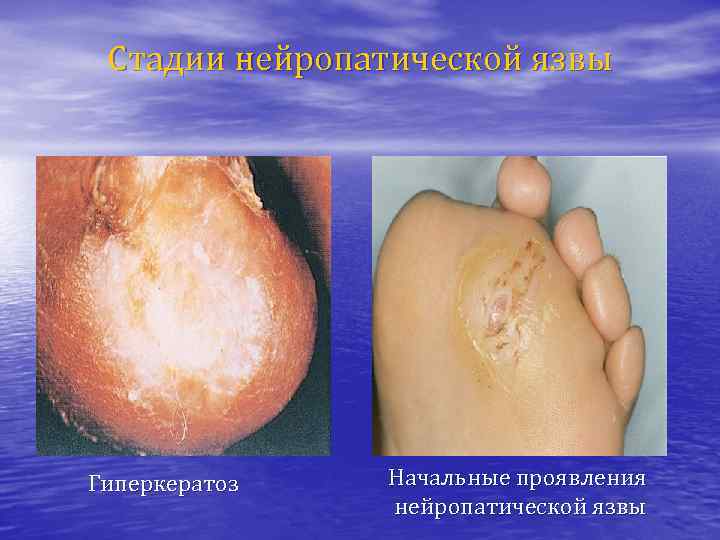 Стадии нейропатической язвы Гиперкератоз Начальные проявления нейропатической язвы 
