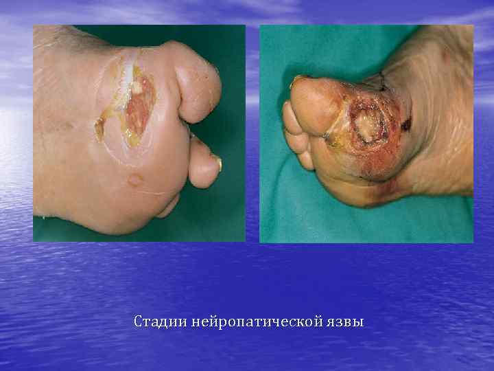 Стадии нейропатической язвы 