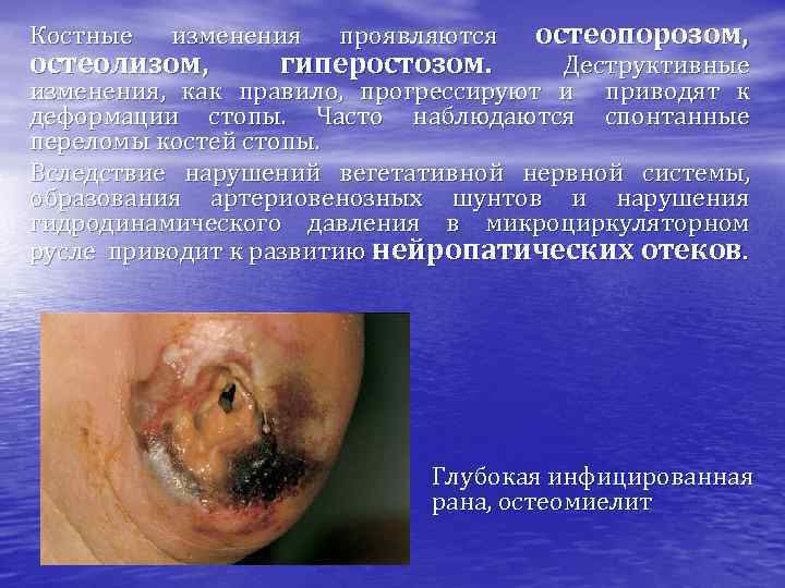 Костные изменения остеолизом, проявляются гиперостозом. остеопорозом, Деструктивные изменения, как правило, прогрессируют и приводят к