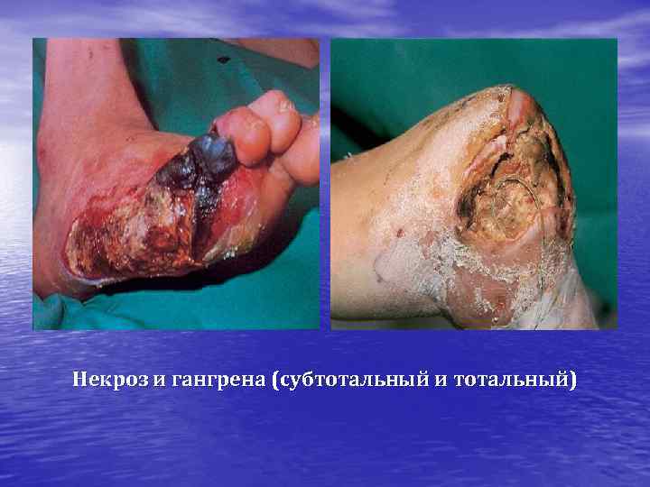 Некроз и гангрена (субтотальный и тотальный) 