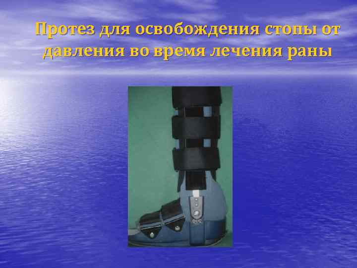 Протез для освобождения стопы от давления во время лечения раны 