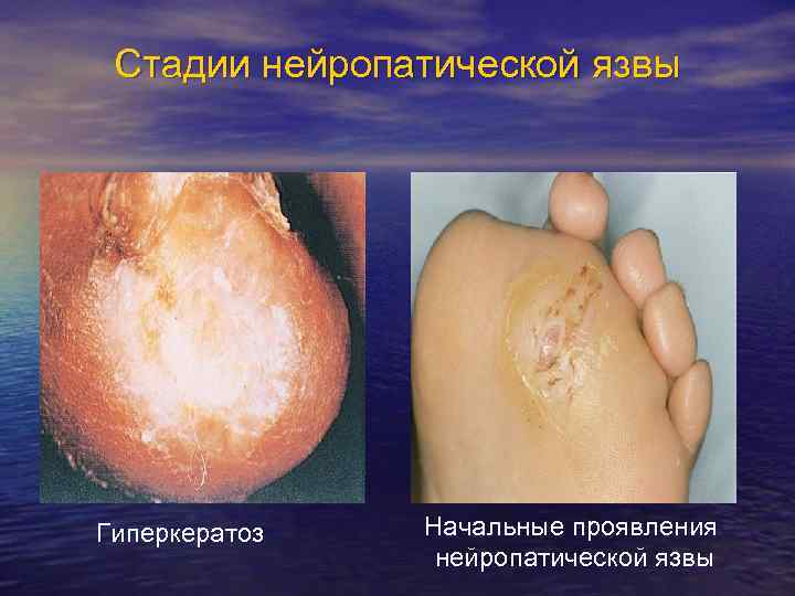 Стадии нейропатической язвы Гиперкератоз Начальные проявления нейропатической язвы 
