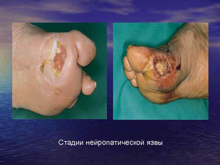 Стадии нейропатической язвы 