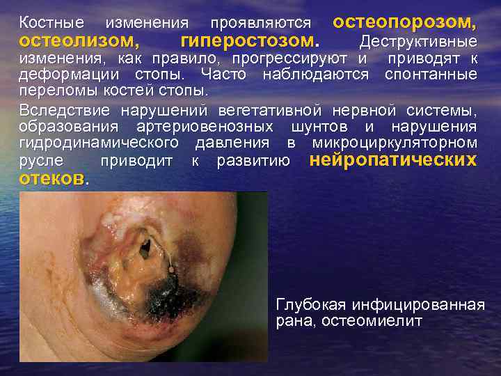 Костные изменения остеолизом, проявляются гиперостозом. остеопорозом, Деструктивные изменения, как правило, прогрессируют и приводят к