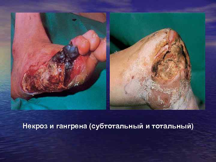 Некроз и гангрена (субтотальный и тотальный) 