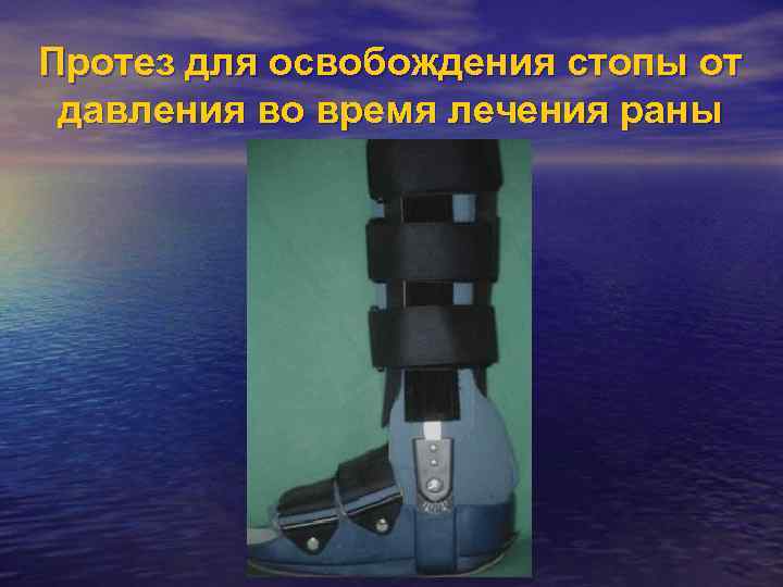 Протез для освобождения стопы от давления во время лечения раны 