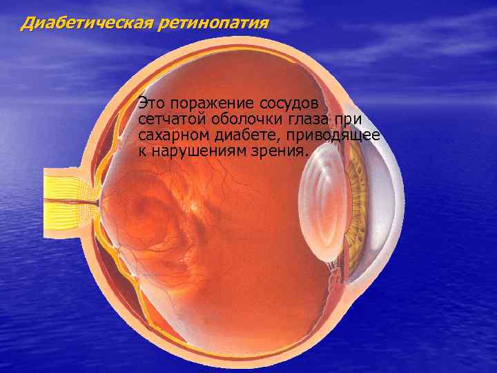 Диабетическая ретинопатия Это поражение сосудов сетчатой оболочки глаза при сахарном диабете, приводящее к нарушениям