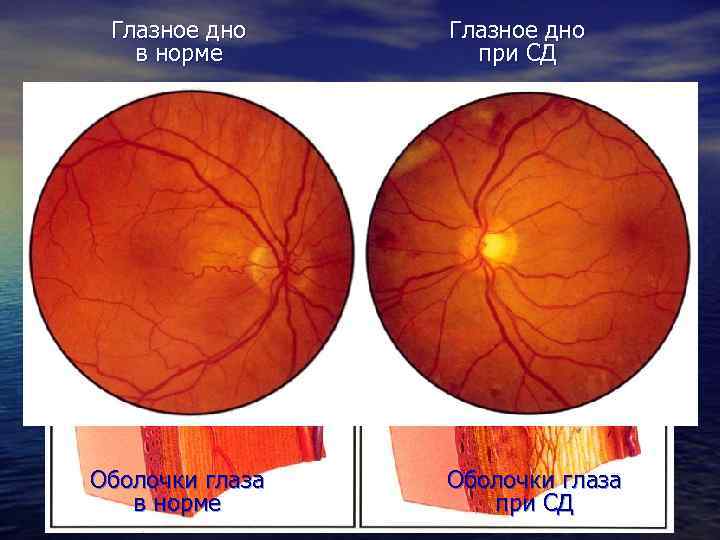 Картина нормального глазного дна