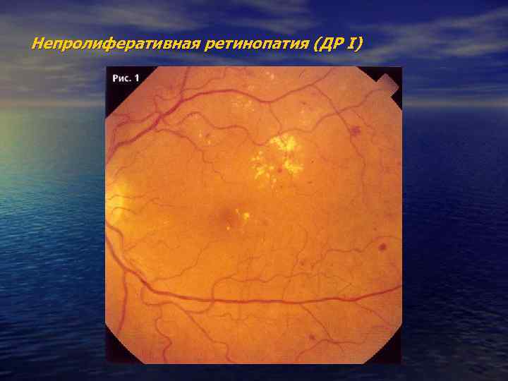 Непролиферативная ретинопатия (ДР I) 