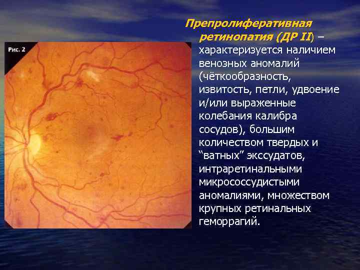 Препролиферативная ретинопатия (ДР II) – характеризуется наличием венозных аномалий (чёткообразность, извитость, петли, удвоение и/или
