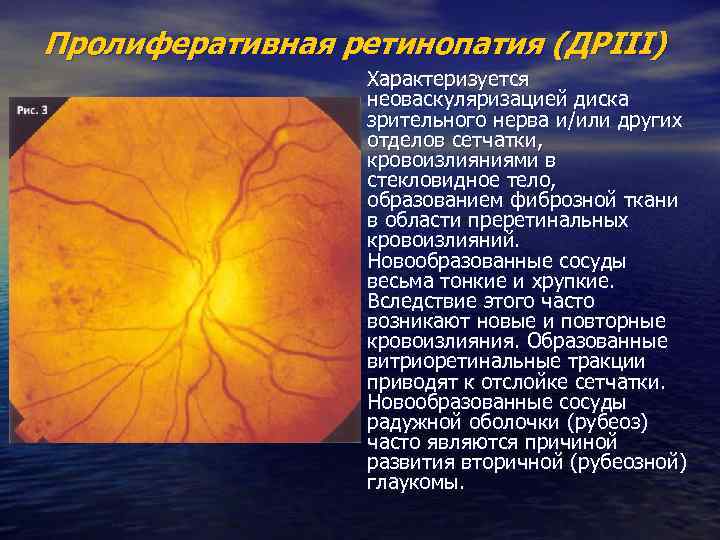 Пролиферативная ретинопатия (ДРIII) Характеризуется неоваскуляризацией диска зрительного нерва и/или других отделов сетчатки, кровоизлияниями в