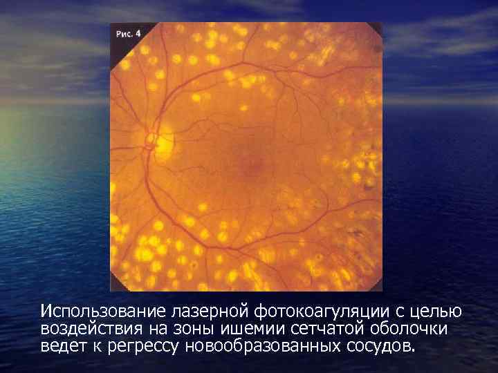 Использование лазерной фотокоагуляции с целью воздействия на зоны ишемии сетчатой оболочки ведет к регрессу