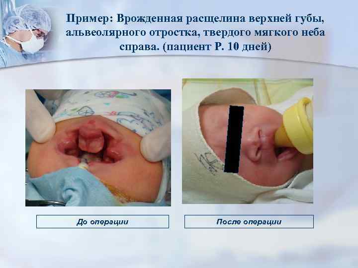 Пример: Врожденная расщелина верхней губы, альвеолярного отростка, твердого мягкого неба справа. (пациент Р. 10