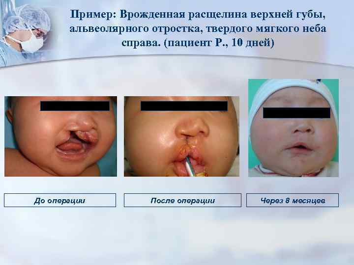 Пример: Врожденная расщелина верхней губы, альвеолярного отростка, твердого мягкого неба справа. (пациент Р. ,