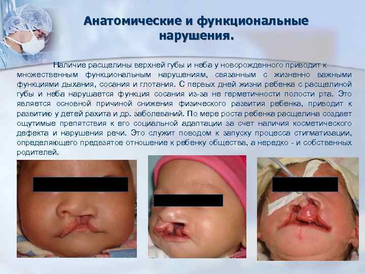 Анатомические и функциональные нарушения. Наличие расщелины верхней губы и неба у новорожденного приводит к