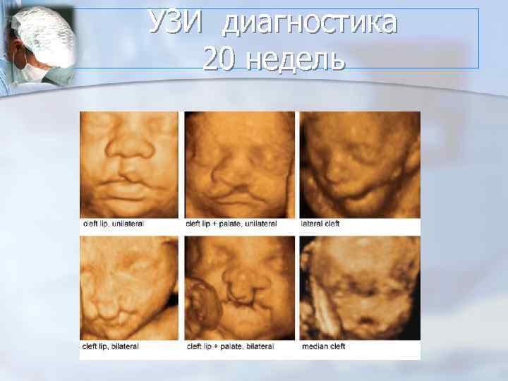 УЗИ диагностика 20 недель 