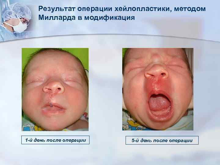 Результат операции хейлопластики, методом Милларда в модификация 1 -й день после операции 5 -й