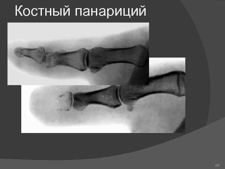 Костный панариций 100 