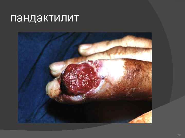 пандактилит 101 