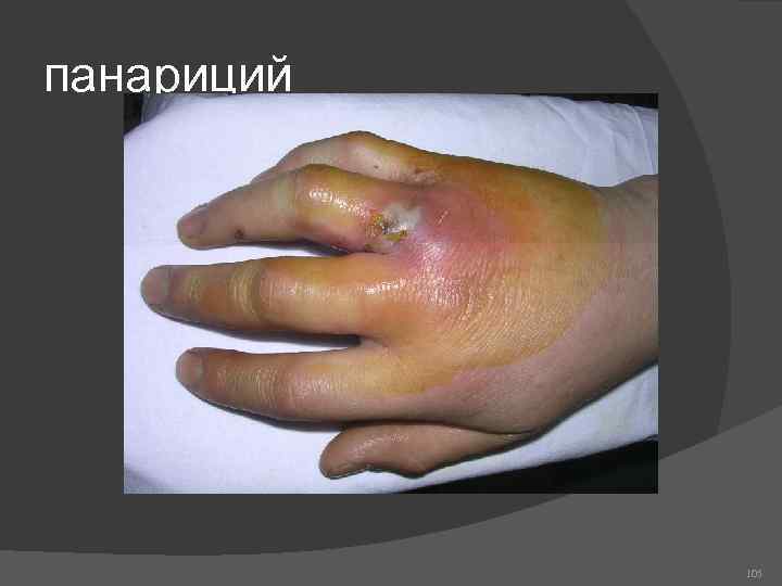 панариций 105 