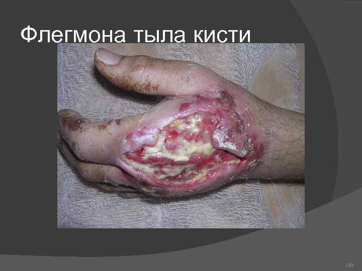 Флегмона тыла кисти 110 