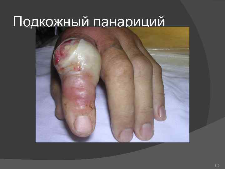 Подкожный панариций 112 