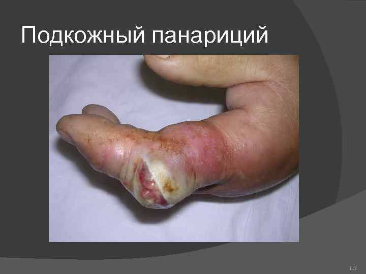 Подкожный панариций 113 