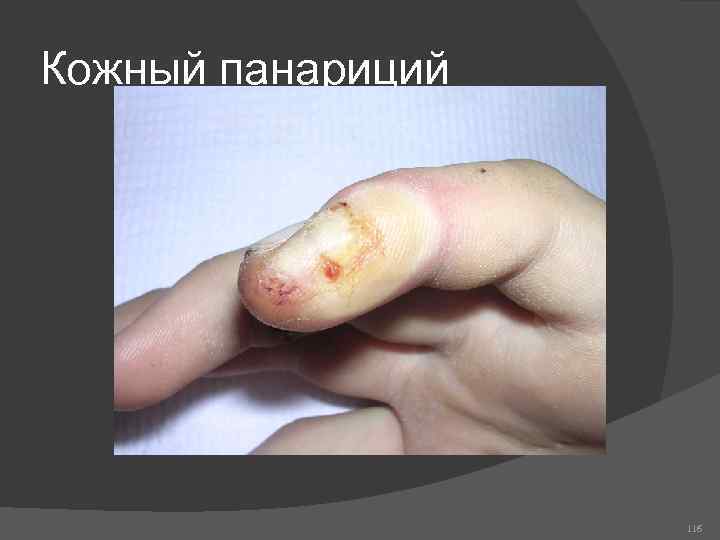Кожный панариций 116 