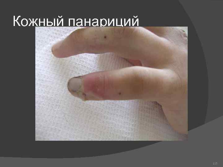 Кожный панариций 117 