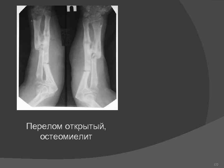Перелом открытый, остеомиелит 122 