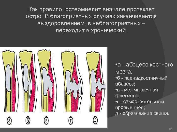 Как правило, остеомиелит вначале протекает остро. В благоприятных случаях заканчивается выздоровлением, в неблагоприятных –