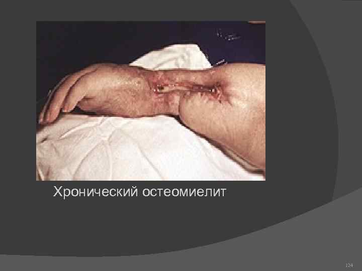 Хронический остеомиелит 124 