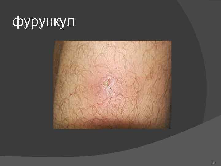 фурункул 14 
