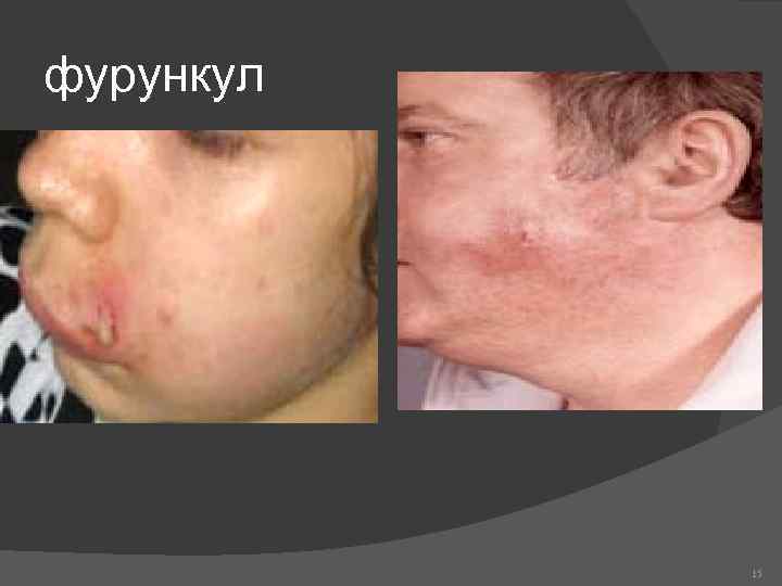фурункул 15 