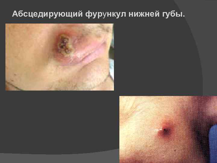 Абсцедирующий фурункул нижней губы. 16 