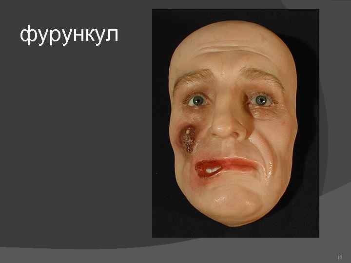 фурункул 17 