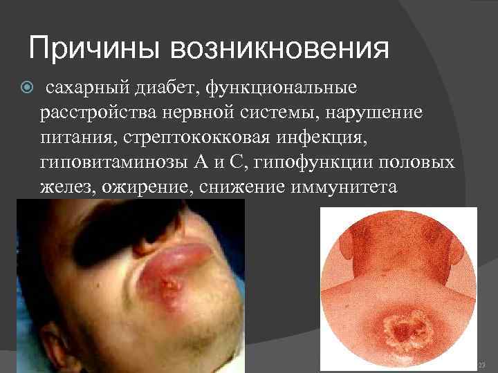 Причины возникновения сахарный диабет, функциональные расстройства нервной системы, нарушение питания, стрептококковая инфекция, гиповитаминозы А