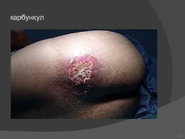 карбункул 25 
