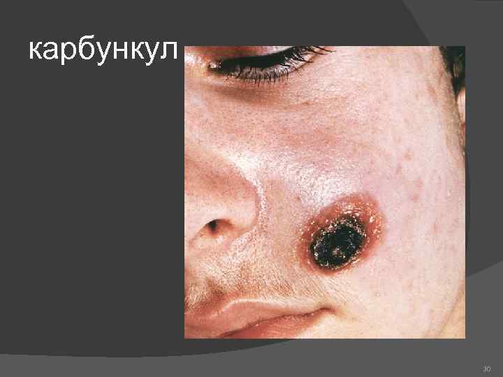 карбункул 30 
