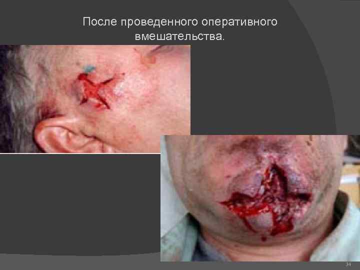 После проведенного оперативного вмешательства. 34 