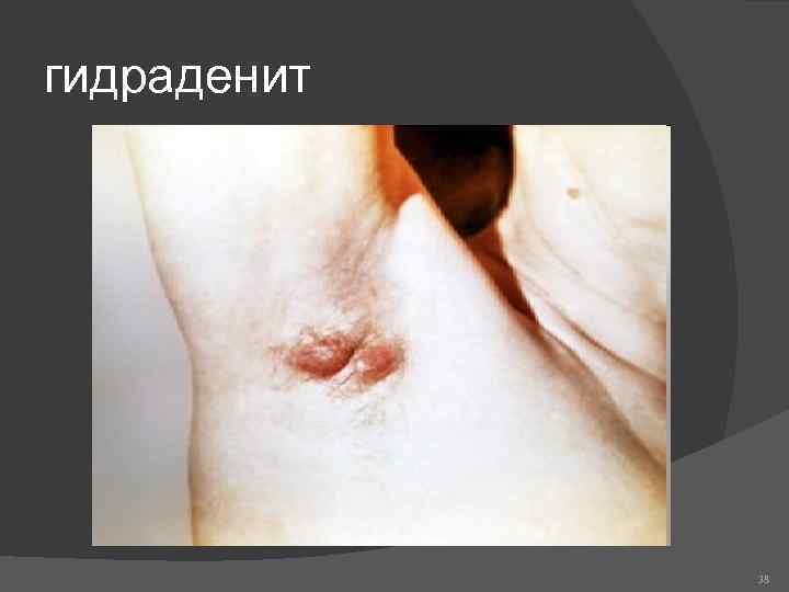 гидраденит 38 