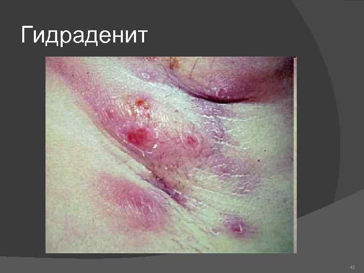 Гидраденит 42 