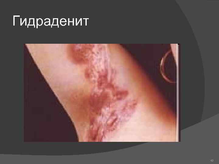 Гидраденит 43 