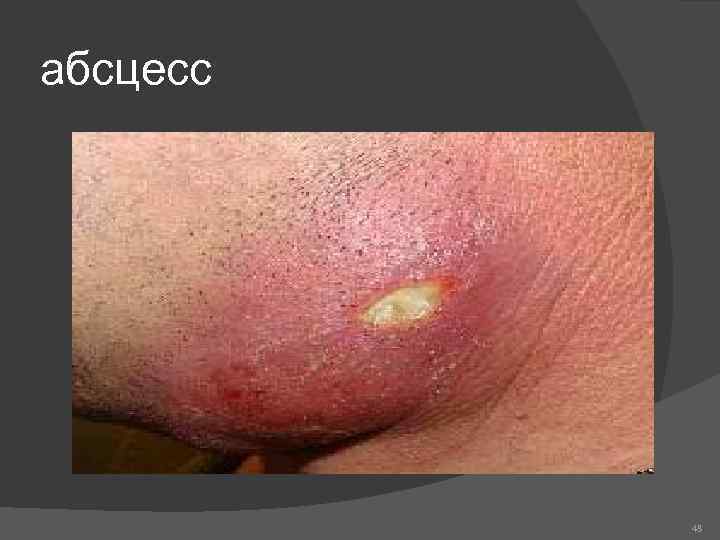 абсцесс 48 