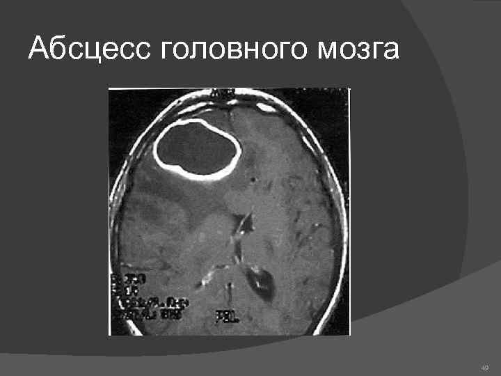 Абсцесс головного мозга 49 