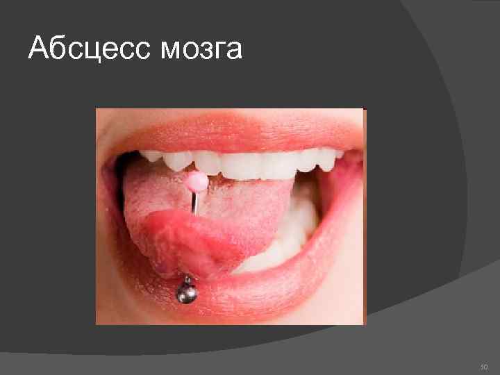 Абсцесс мозга 50 