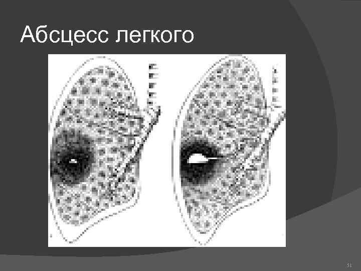 Абсцесс легкого картинки