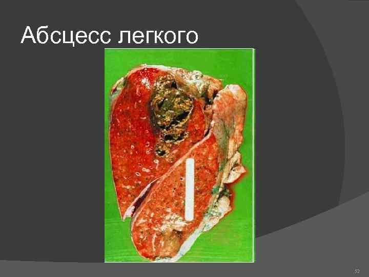 Абсцесс легкого 52 